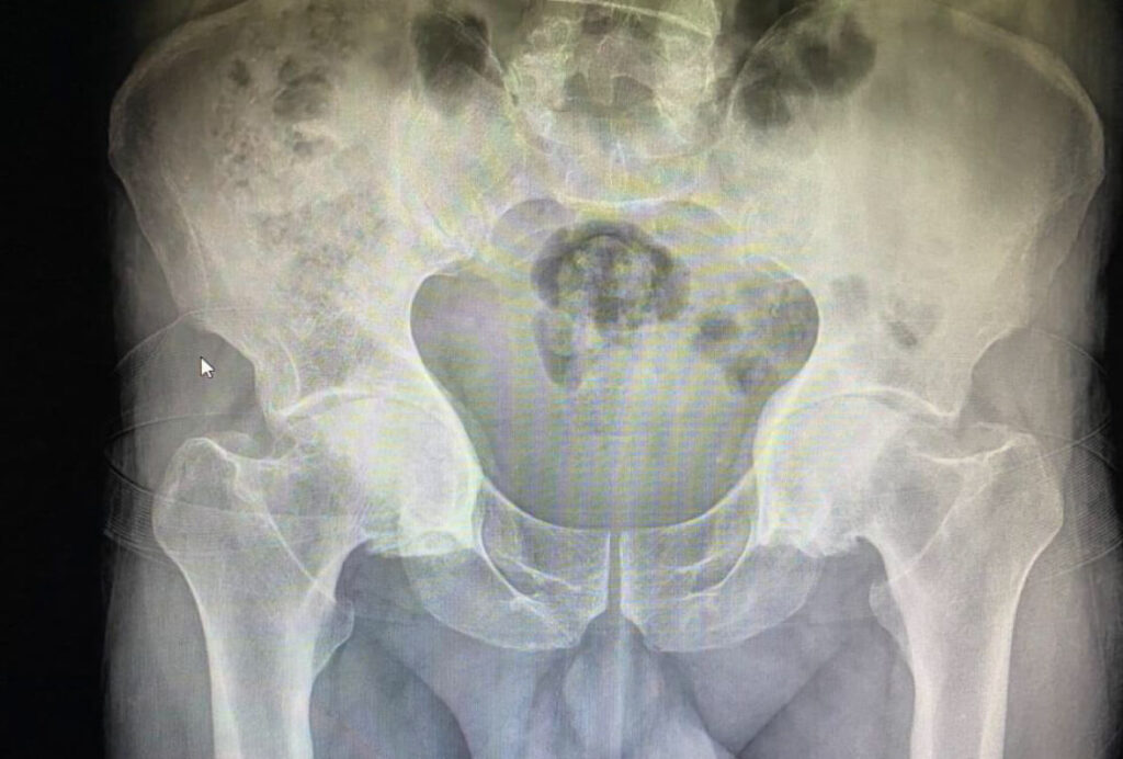 Artrosis Bilateral De Caderas