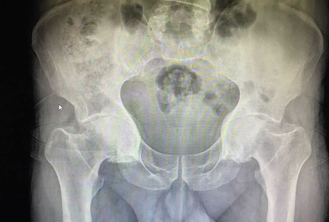 Artrosis Bilateral De Caderas
