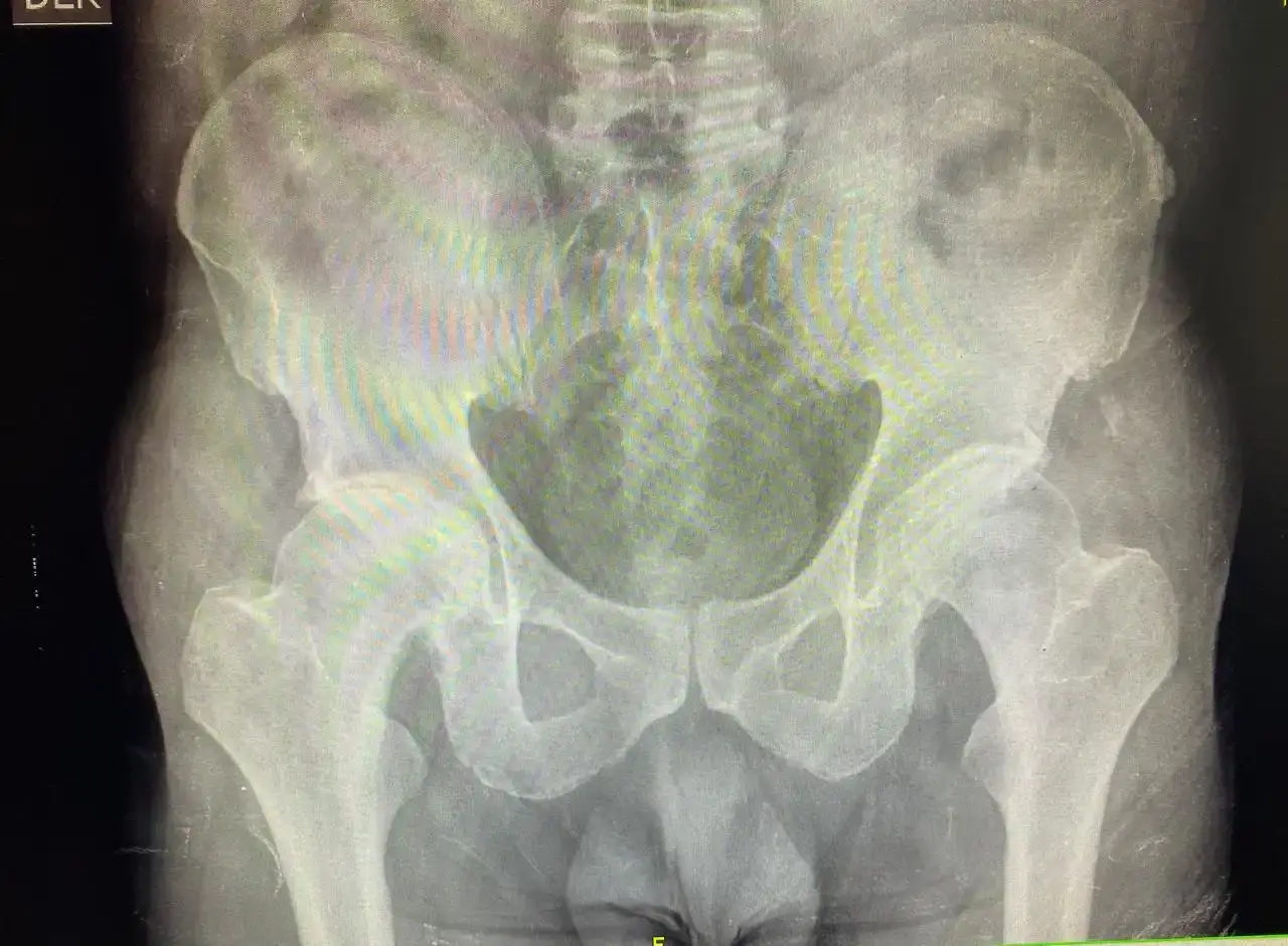 Reemplazo bilateral de cadera