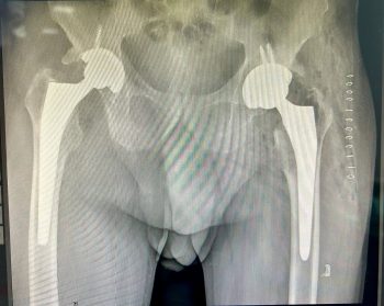 Cirugía de cadera por vía anterior ambulatoria.